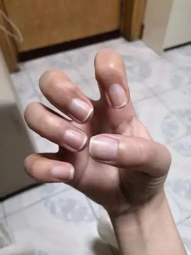 有人像我一样指甲是发紫和灰白色吗