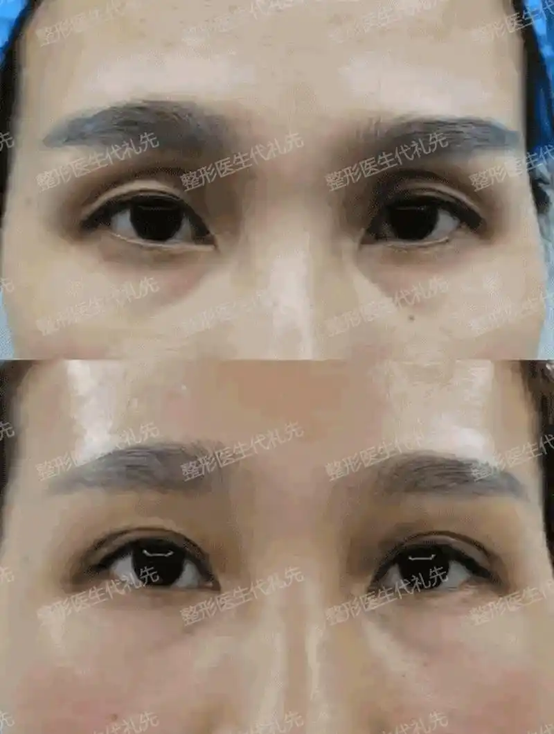 求美者眼窝凹陷,填充脂肪胶后术后即刻,眼窝缺失的容量得到填充,重新