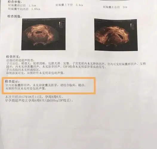 去医院做b超看到单子上写"未见胎心胎芽",小李以为又和上次一样,结果