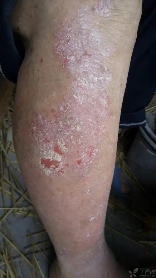 83岁,右下肢小腿皮肤发痒1月半,起初疮口不大,先逐渐变大趋势,是癣