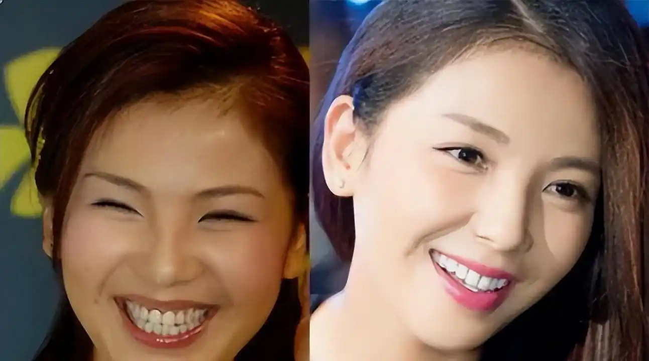 娱乐圈那些整牙的明星,刘涛300万烤瓷牙精致,而他却是翻车现场_牙齿