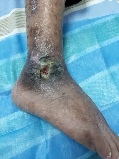 院内伤口护理手册