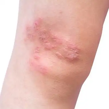 湿疹图片和症状 (46)