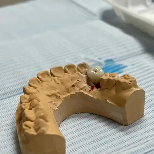 种植牙终结版07