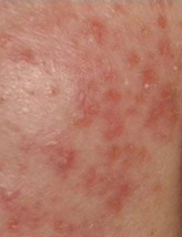 脸部得湿疹怎么办?