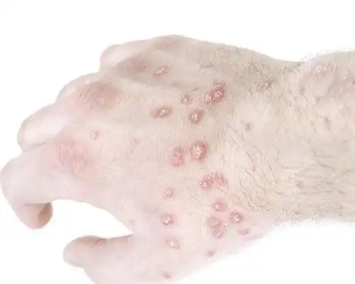 身上一块块干燥像癣不痛不痒图片