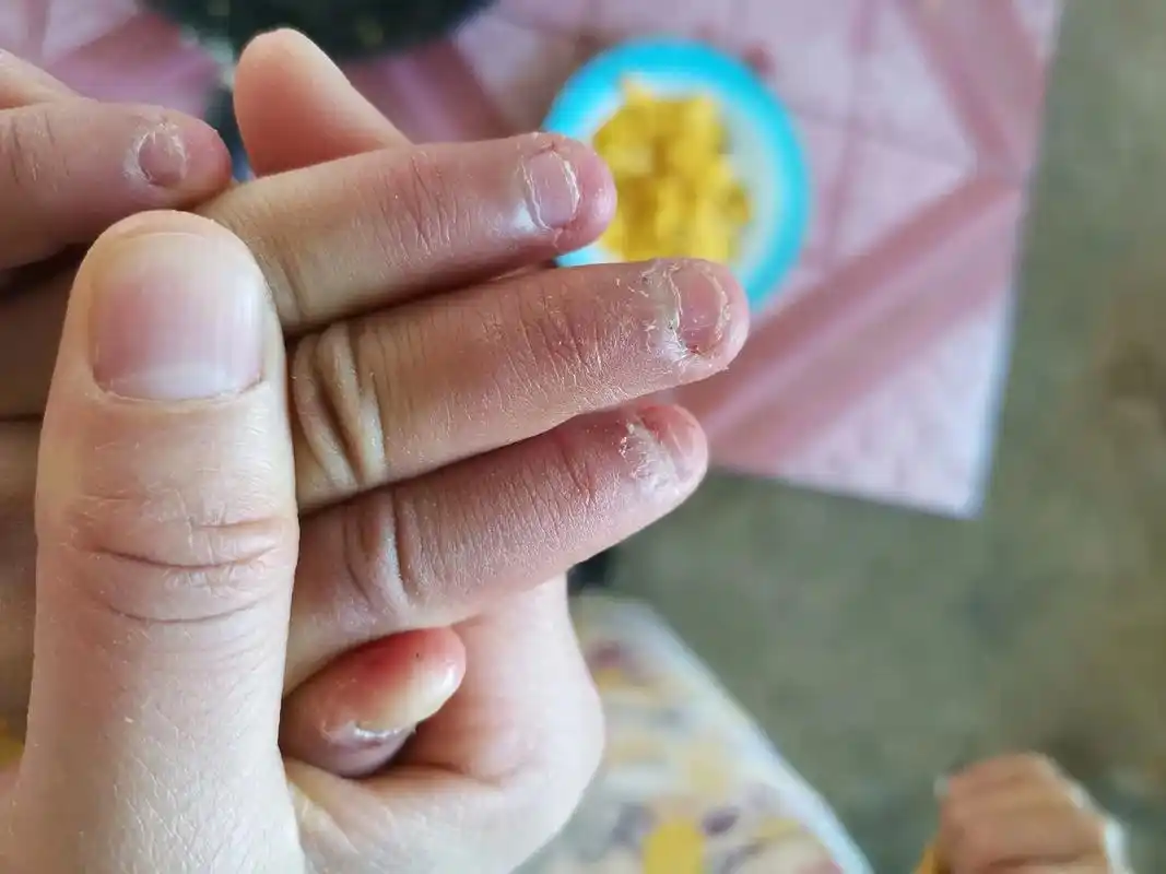 老爱咬指甲  怎么都改不了010101    指甲都发炎了还 - 抖音