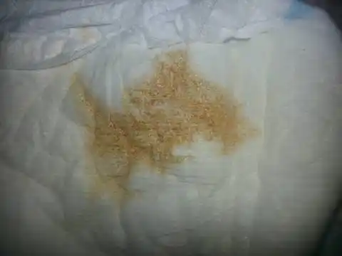 急急急,宝宝小便有咖啡色物质