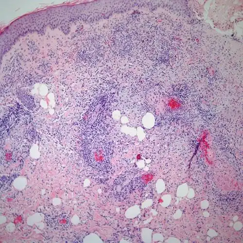 图说 ▍非霍奇金淋巴瘤(下篇)