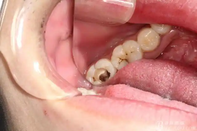 一例右下第二磨牙橡皮障与热牙胶的联合应用