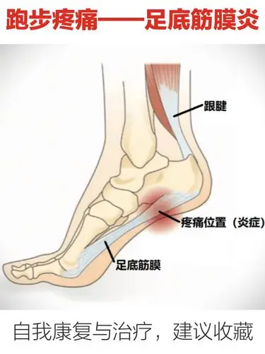 【建议收藏】跑步伤痛|足底筋膜炎