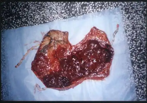 三胎妊娠帆状胎盘