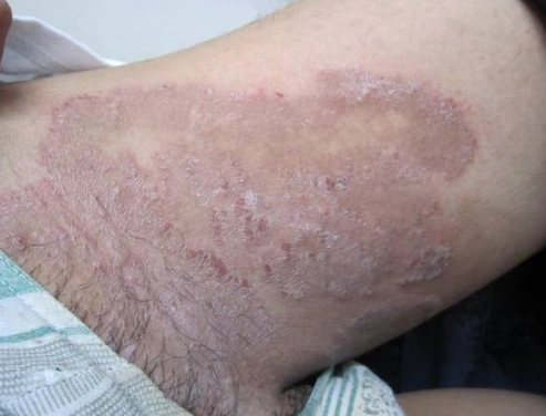 体癣图片_体癣症状表现图片大全_有来医生