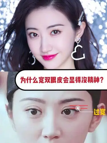 整了青蛙眼后的景甜重新美回巅峰,为什么宽双眼皮会显得没精神