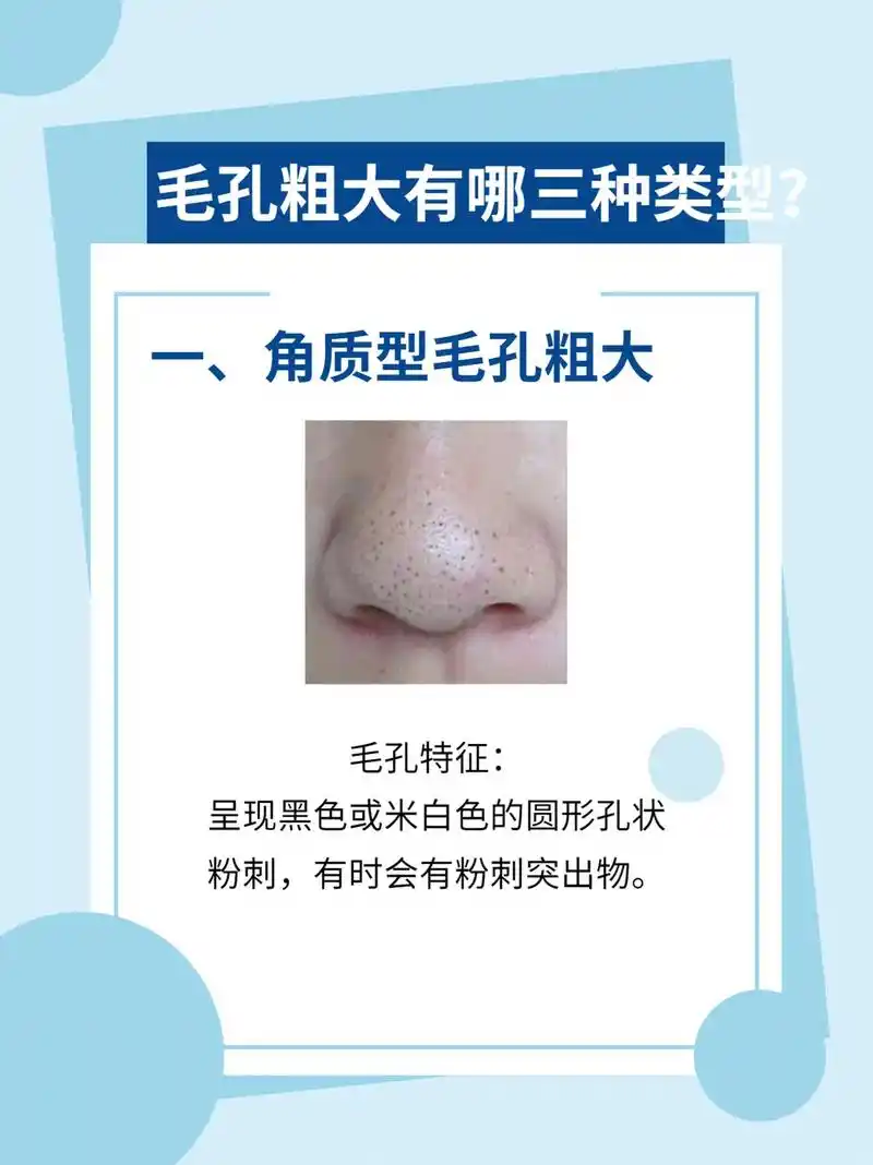 毛孔粗大三种类型针对护理才有效