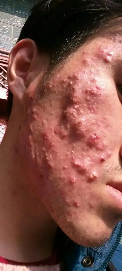 有了工作,因为是基层人员,有夜班,平时上班的环境有灰尘,脸上的毛囊炎