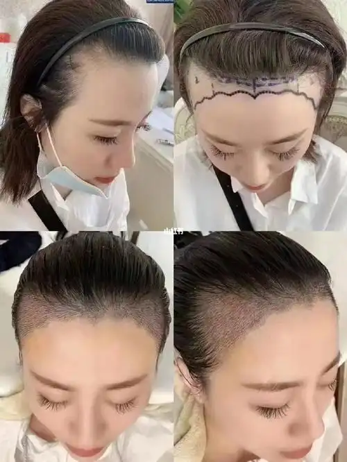 小姐姐植发前后对比