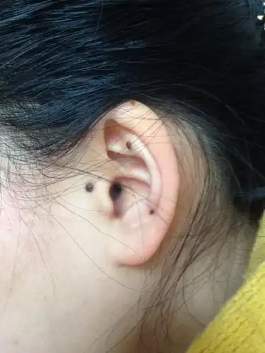 耳朵长痣好吗?面相上怎么解释,第一张是左耳朵.第二张是右耳朵