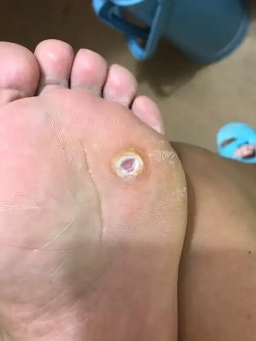 各位医生帮我看看,鸡眼根这样彻底是挖出来了吗?