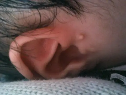 宝宝耳朵上有个肉丁,出生时就有的,不知怎麼处理!