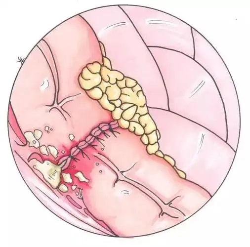 前瞻性研究395例0/i期直肠癌病人,在接受腹腔镜低位前切除加双吻合器
