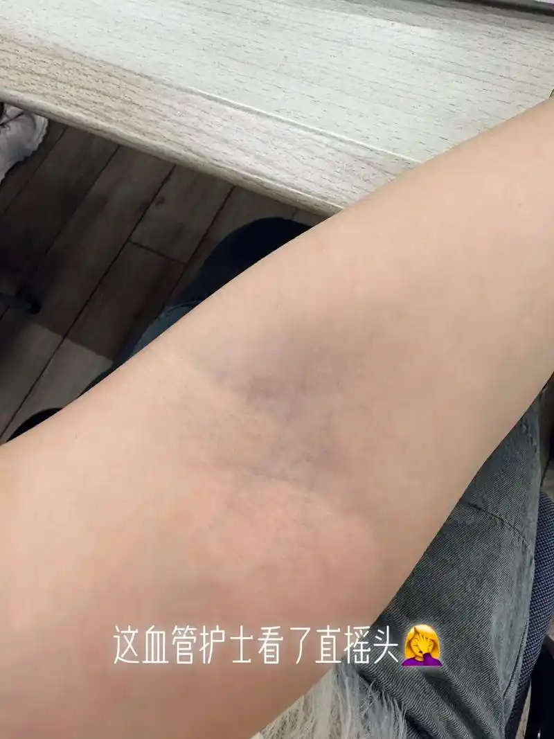 体检抽血胳膊肘找不到血管 - 抖音