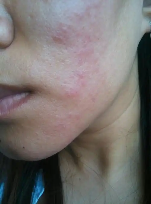 脸上发红,起红疹,有小白水泡,医院说过敏性皮炎治疗了一个月也没好,有