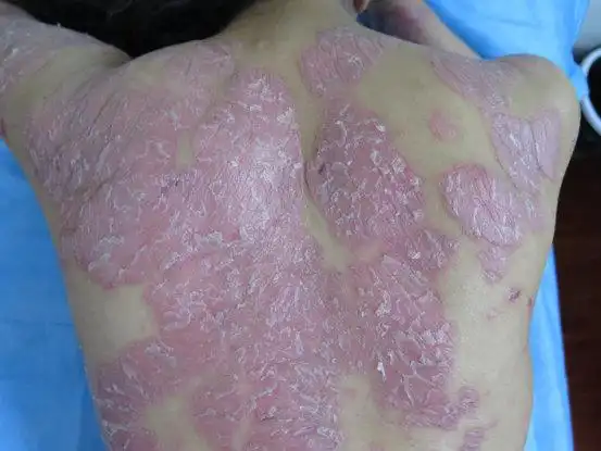 银屑症状图片早期_银屑病求医网