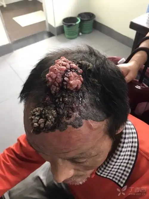 这一例头皮肿块,看得我头皮都发麻了!