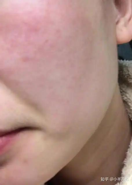 有红血丝的皮肤如何化妆?