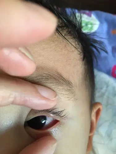 三岁儿子右眼睑红,发现当天晚上姥姥误把红霉素软膏涂点在眼睛里,第