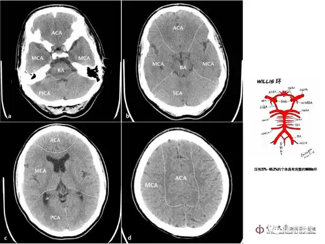 超实用急诊头颅ct3b阅片法
