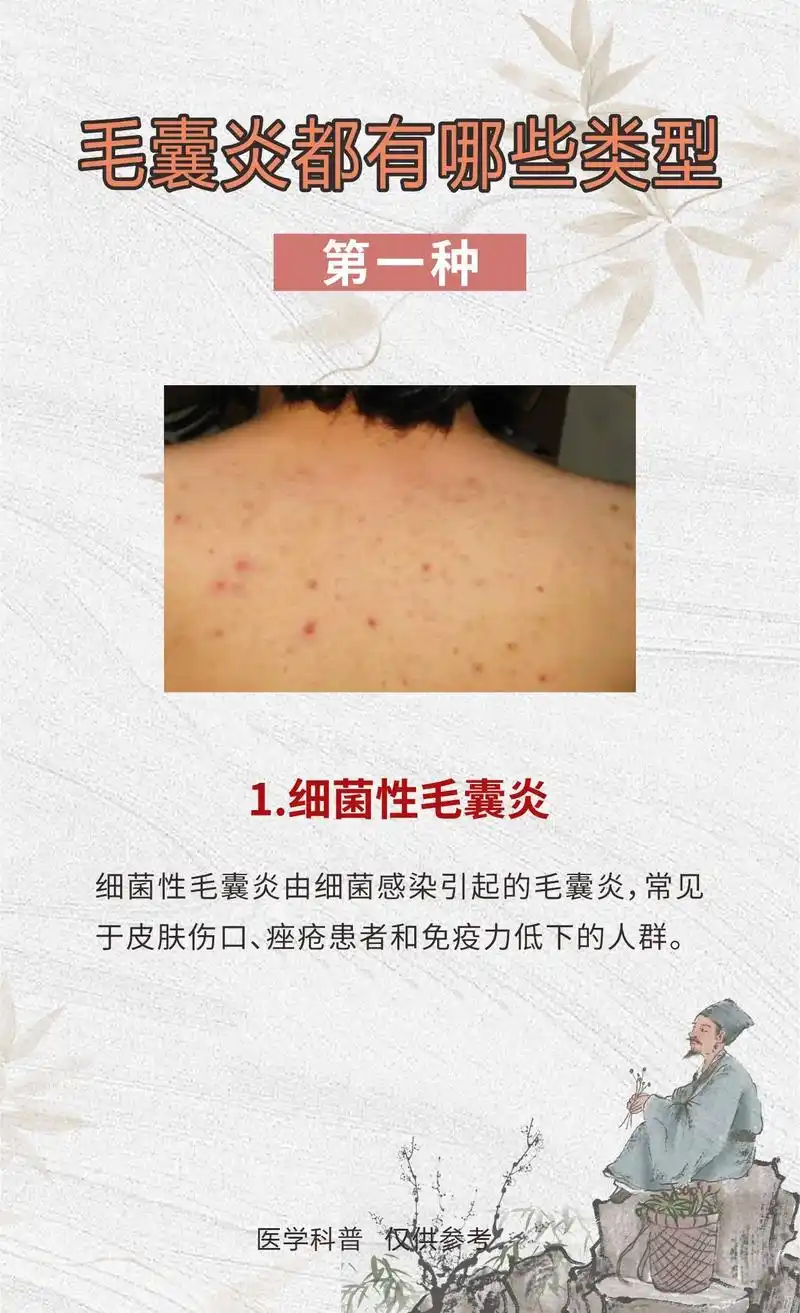 毛囊炎都有哪些类型,你知道吗.#医学科普 #皮肤病 #皮肤问 - 抖音