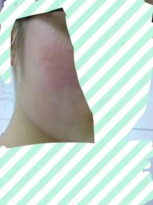 之前好像有一点点化妆品过敏,但没看医生所以不太确定.现在脸