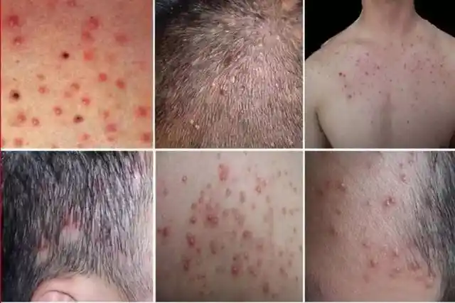 干货|看图识病系列1:毛囊炎