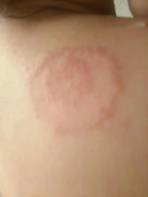 肩膀上的皮肤变成这样了,去医院说是皮炎,搽药膏也不好,大了两倍了