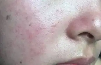 面部敏感,泛红,刺痛?教你敏感肌肤的解决之道_皮肤