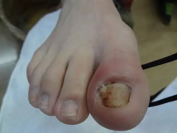 甲沟炎大部分是因为真菌感染引起的,再就是剪指甲不注意,剪的过深