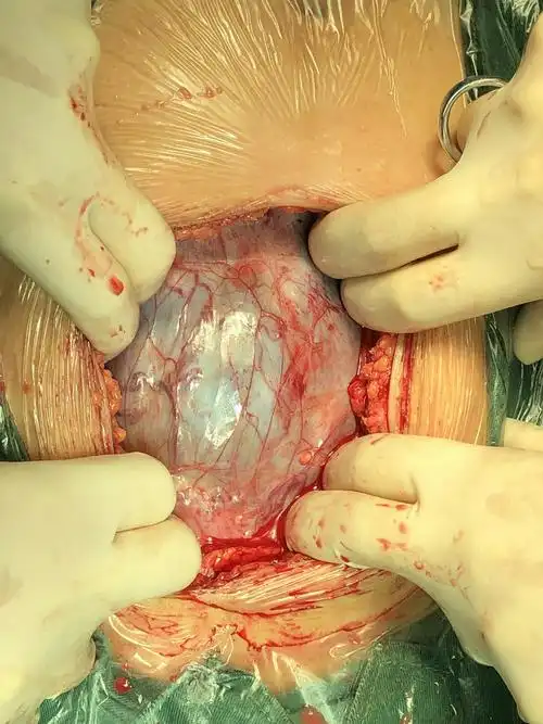 "保子宫,零输血"_我院凶险性前置胎盘并植入手术日记