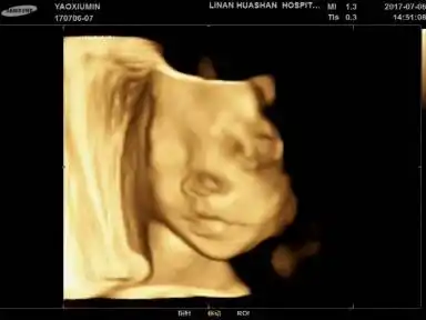 各位大姐帮忙看下宝宝四维彩超头像鼻子正常吗?