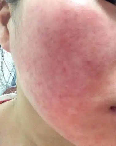 这2天脸为什么会这样,发红,发痒,干干的,红肿,感觉皮肤没弹性,有点
