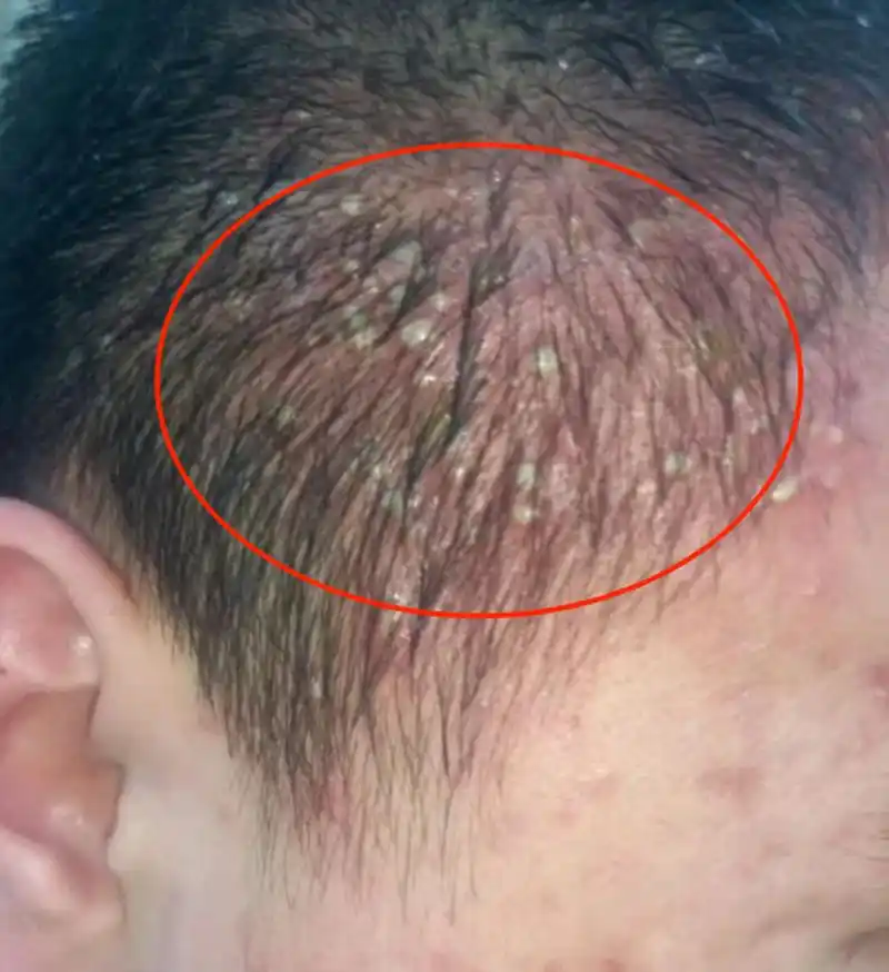 毛囊炎一般分为2种: 一种是常见的普通型毛囊炎, 另一种症状较重且