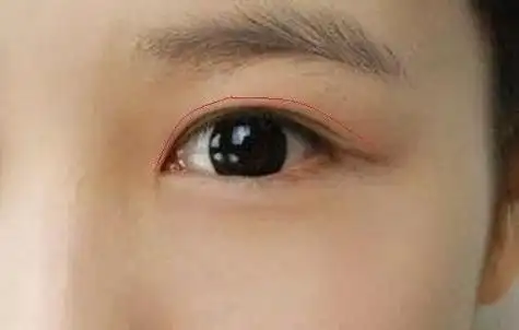 内双适合做哪种双眼皮手术,眼整形哪种风格效果更自然?