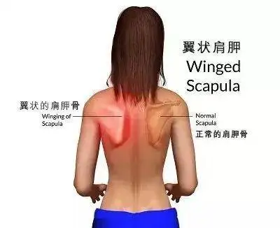 肩胛骨|蝴蝶肩|脊柱