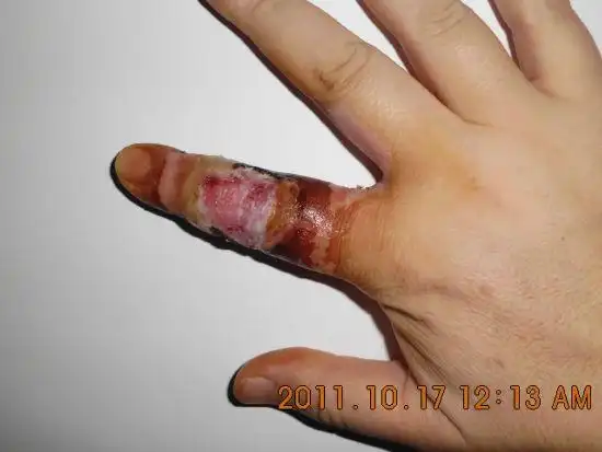 使用后溃烂的手指.央视提供