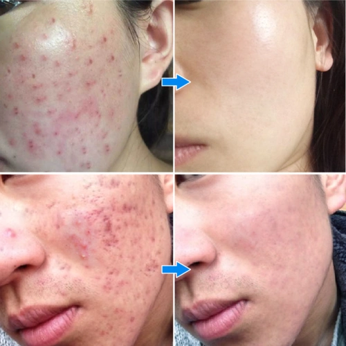 本草堂祛痘膏15g 去痘印痘疤粉刺 中药护肤温和祛痘产品 男女通用