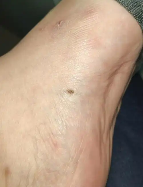 左脚先天的黑痣变大了,有事吗