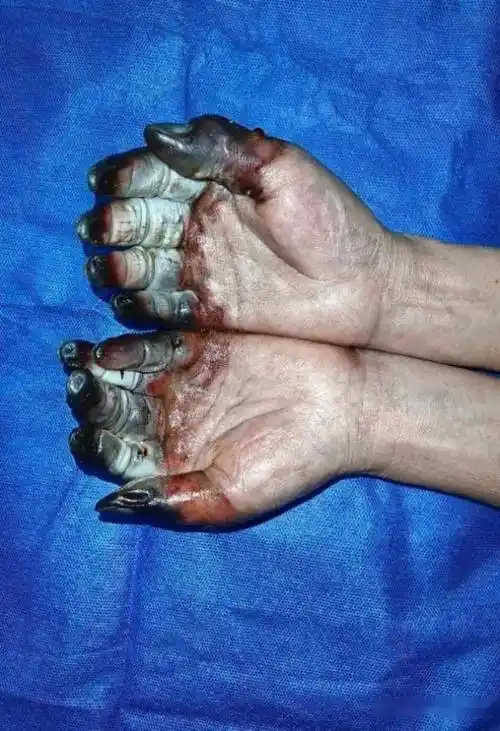 有人被截肢!出去旅游请注意._皮肤_进行_天气