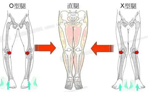 婴儿内八字腿怎么矫正,腿内八字怎么办?