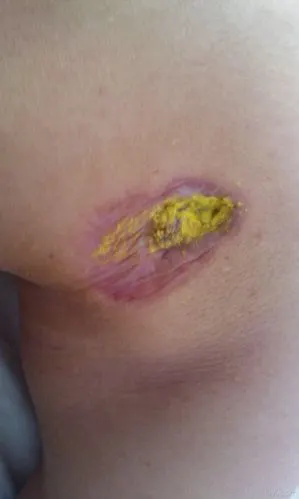 新接的一例皮肤溃疡,向大家请教 - 皮肤及性传播疾病讨论版 - 爱爱医